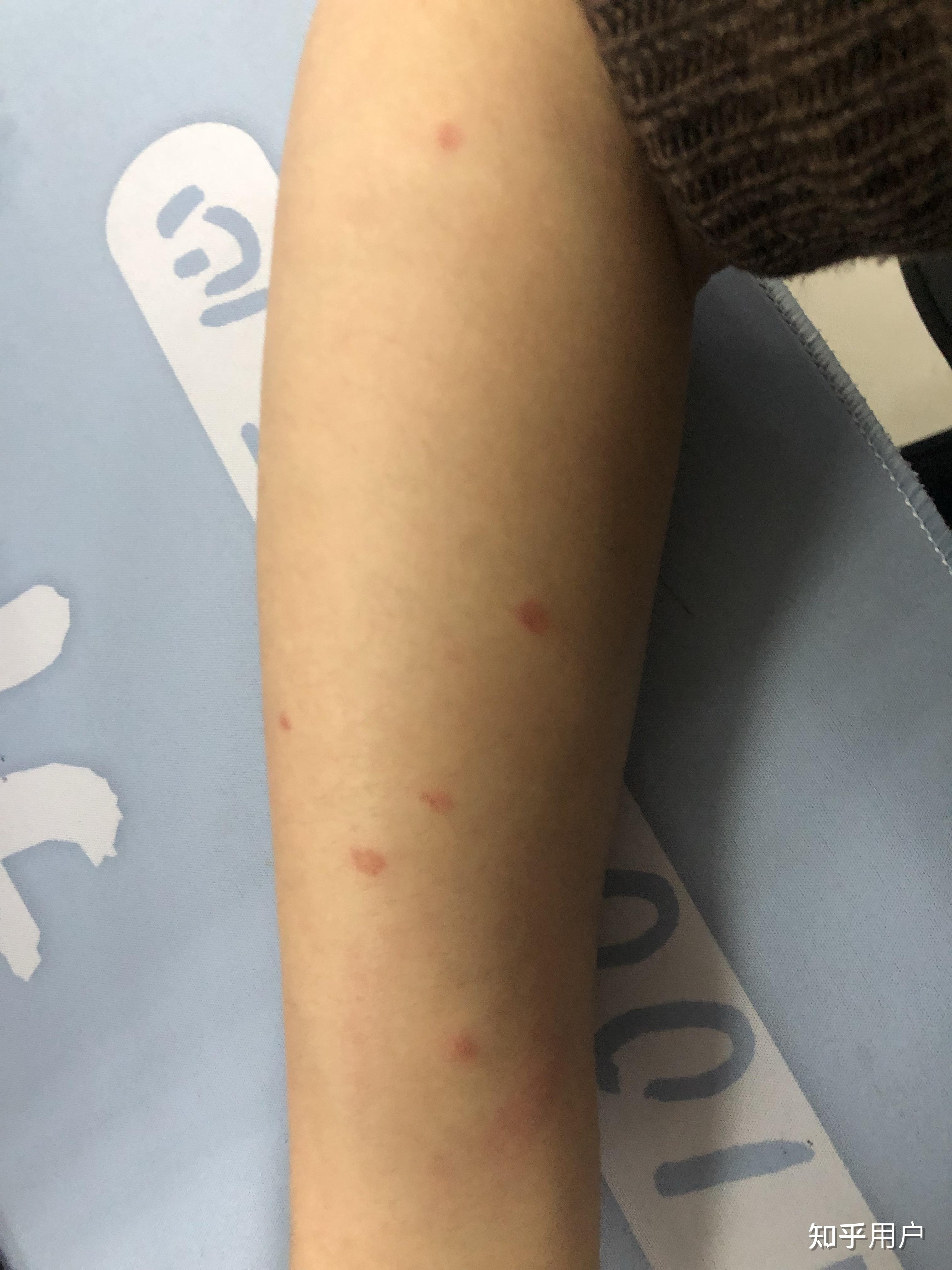 人长猫藓什么样子