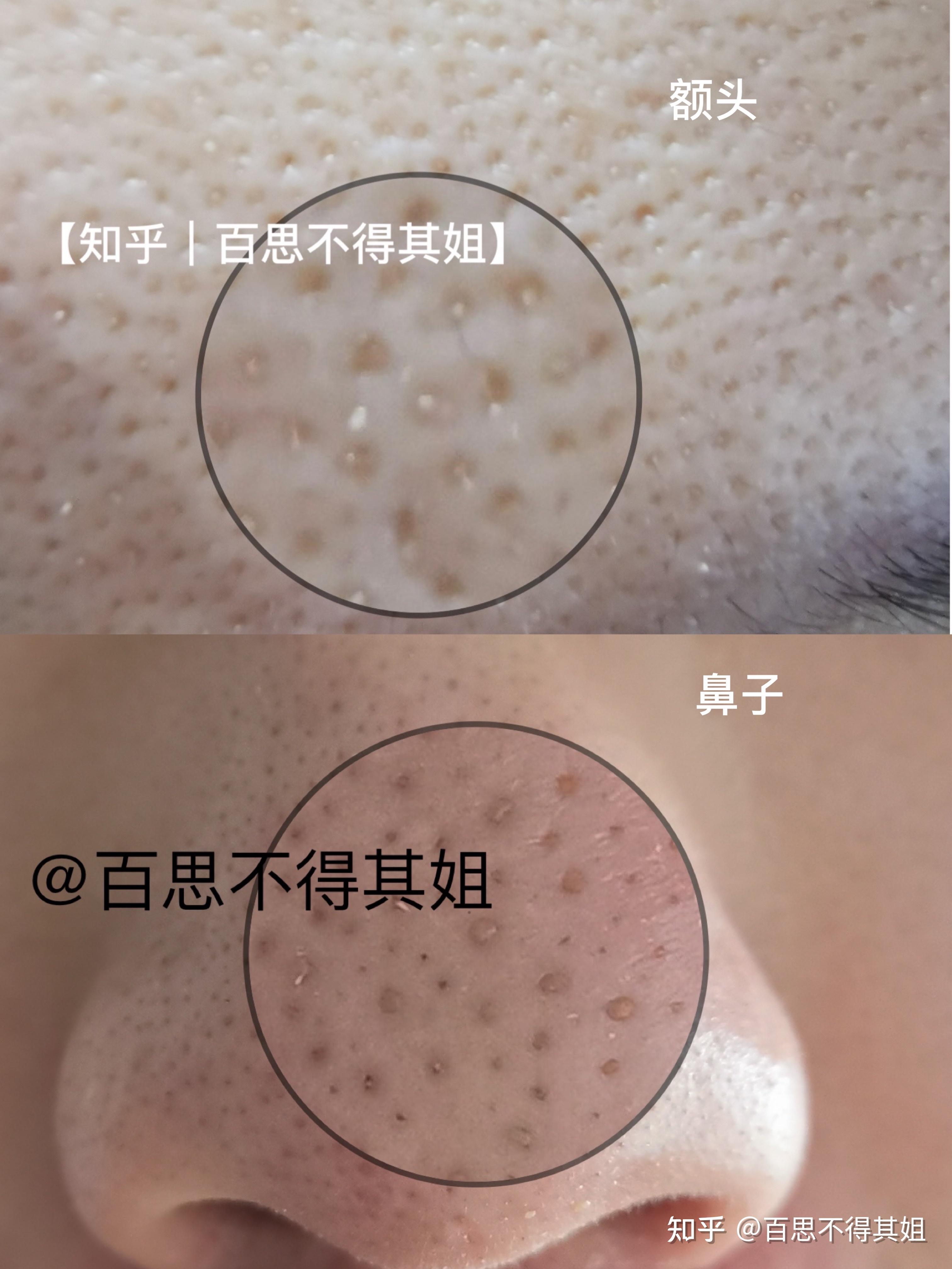 脸颊上能挤出一粒粒黄色颗粒物,这是什么?怎么办才能彻底消除?