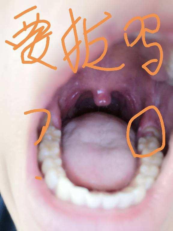 立世牙什么是立世牙拔掉它会有窟窿吗