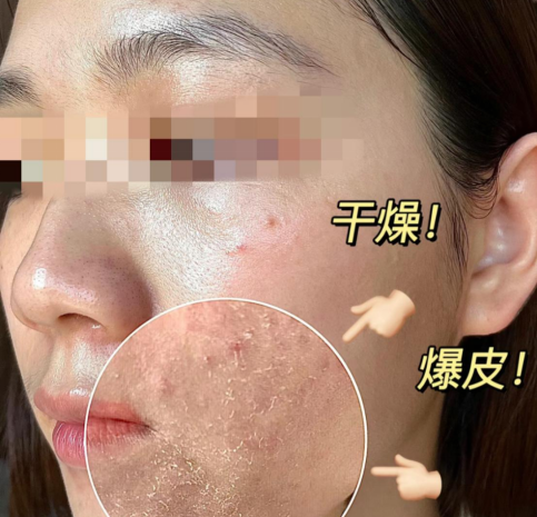 干皮女生该如何护肤？ - 知乎