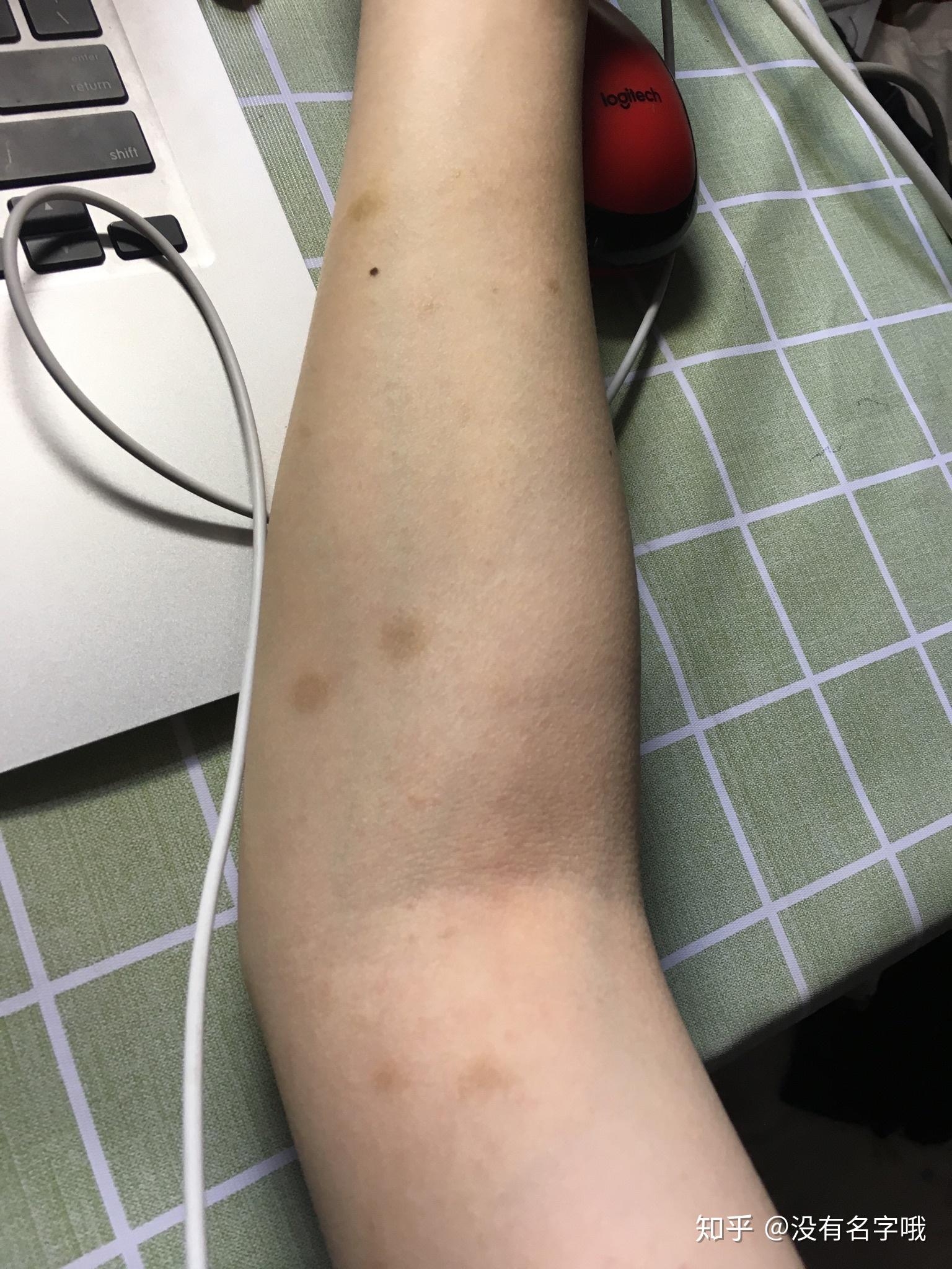 丘疹性荨麻疹留下的疤痕怎么去除