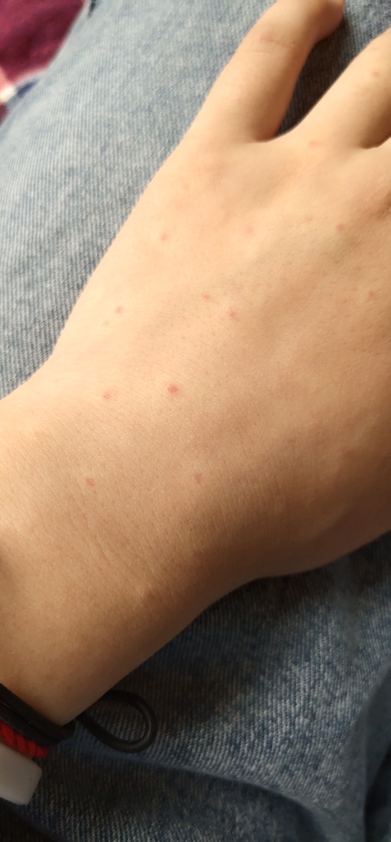 有没有人手上或胳膊上出现小红点按压变白松开变红