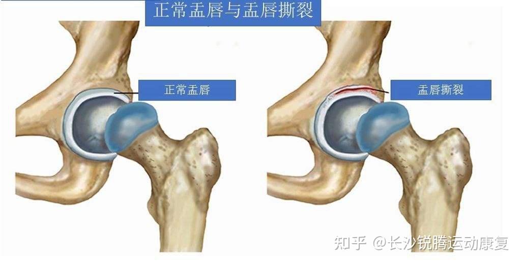 髖臼盂唇損傷是盂唇撕裂嗎