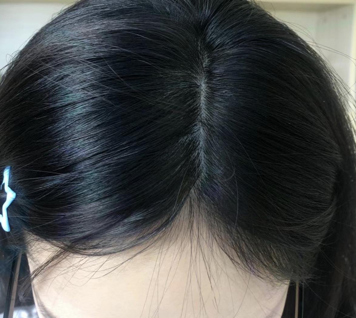 女生头顶头发少是什么体验 ?