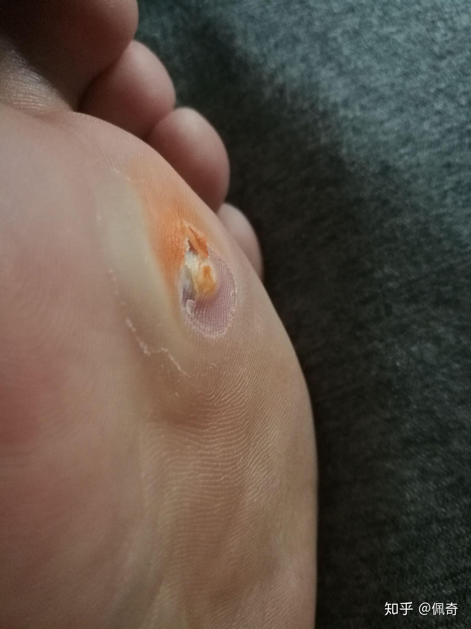 长了鸡眼要怎么治疗比较好呢