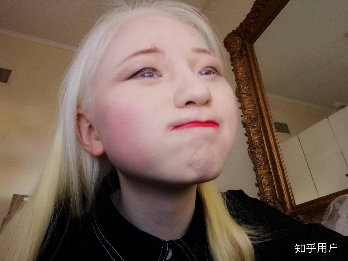 白化病人的一生是怎样的