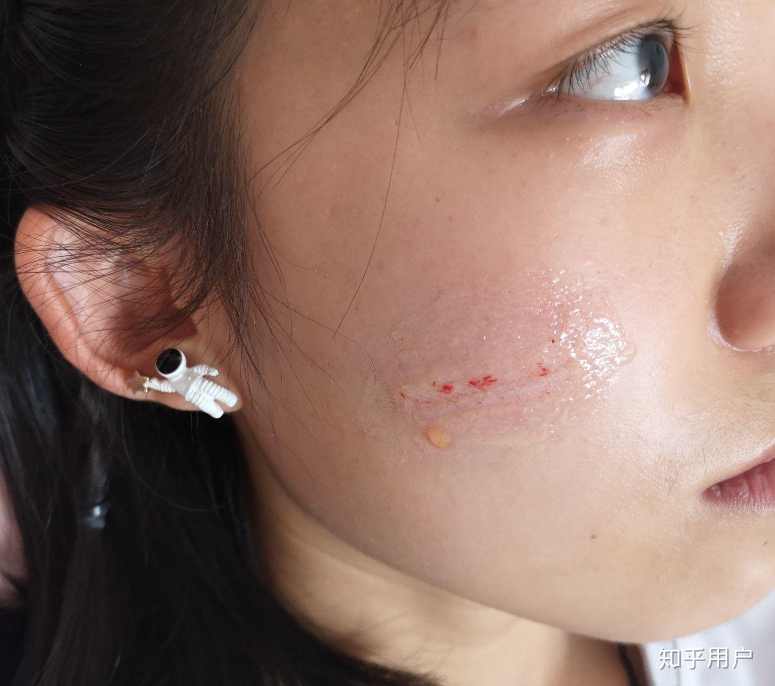 小时候打架脸上被抓了很多疤痕,可以怎么修复疤痕? 