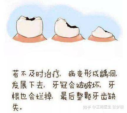 牙齿只剩牙根了,拔掉or留下?怎么处理? - 知乎