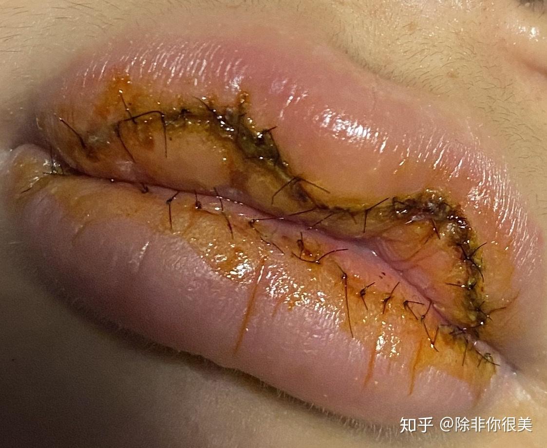 讲讲厚唇切薄术,会不会反弹,真的有效果嘛? - 知乎