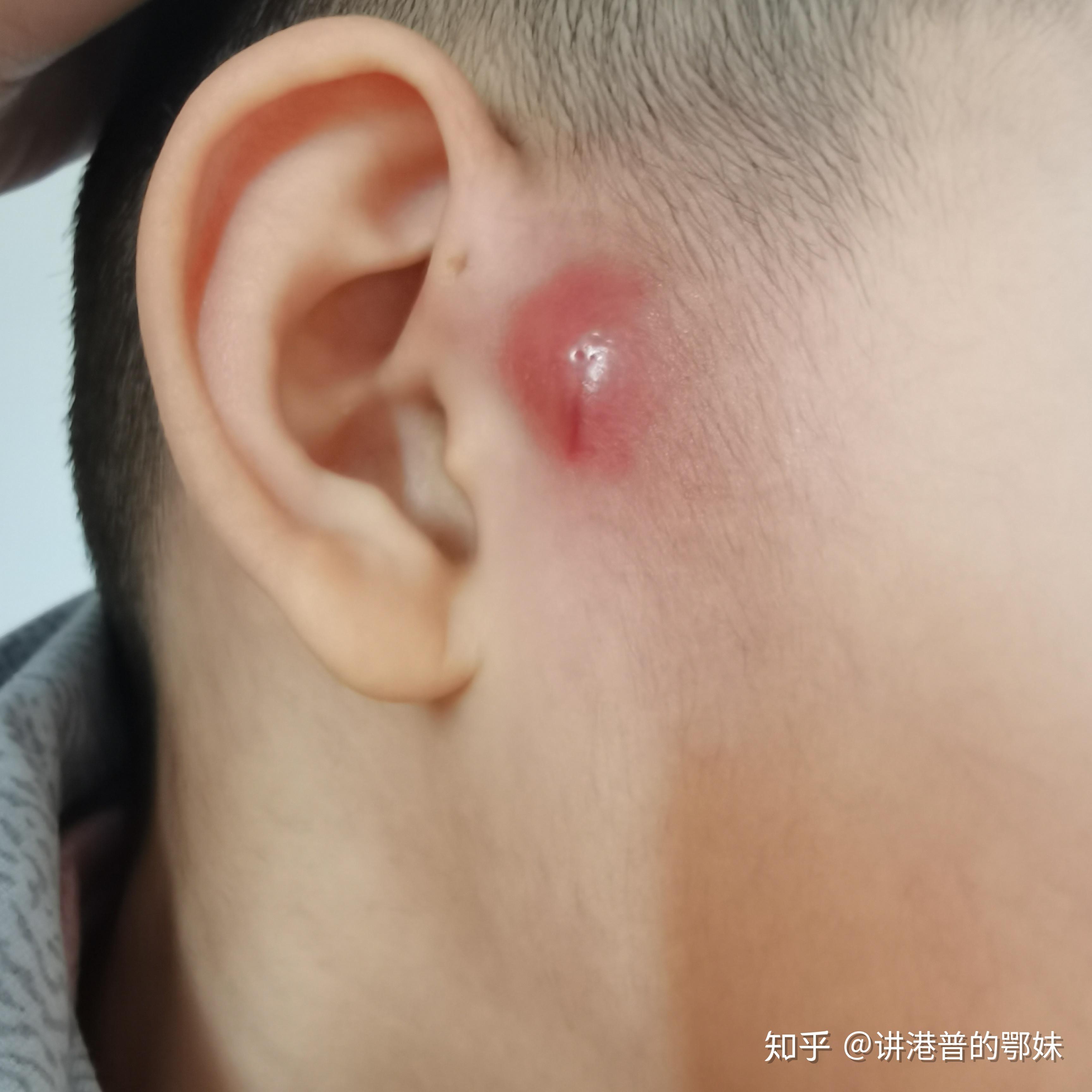 耳前瘘管发炎了能做手术吗