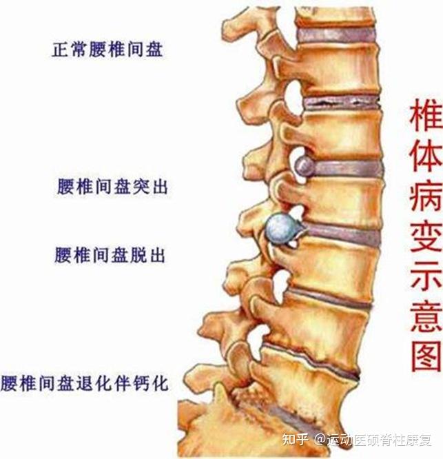 椎间盘突出=椎间盘突出怎么治疗好得快