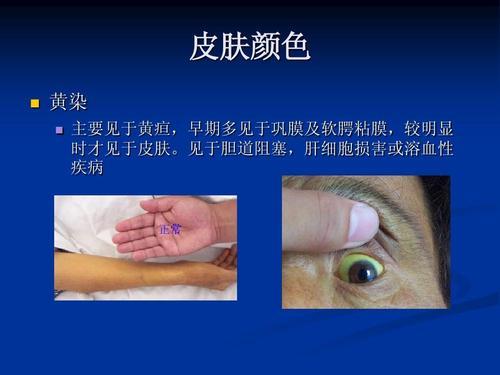 巩膜黄染可能是什么原因导致？ - 知乎