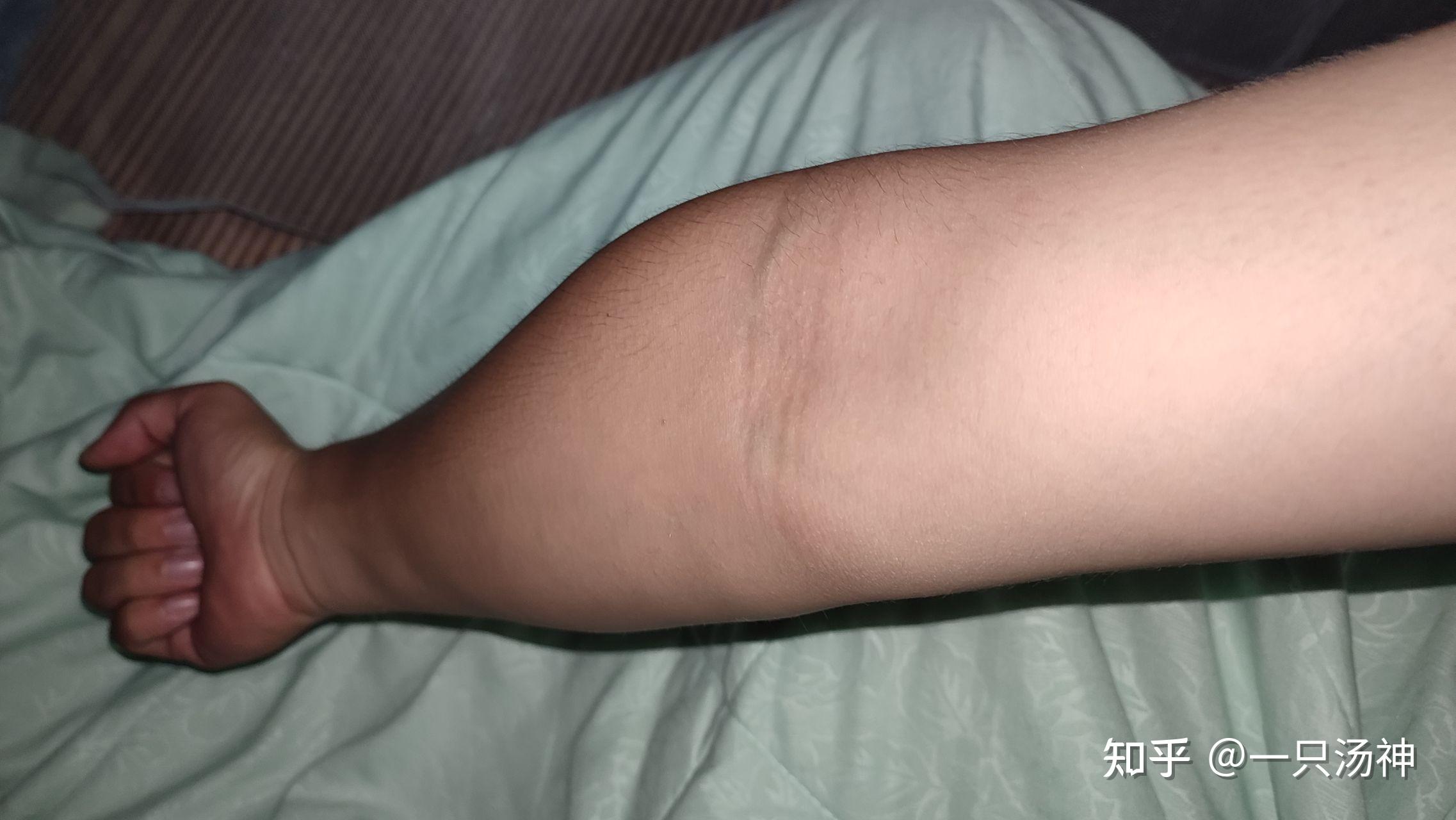 肘外翻有什么影响吗