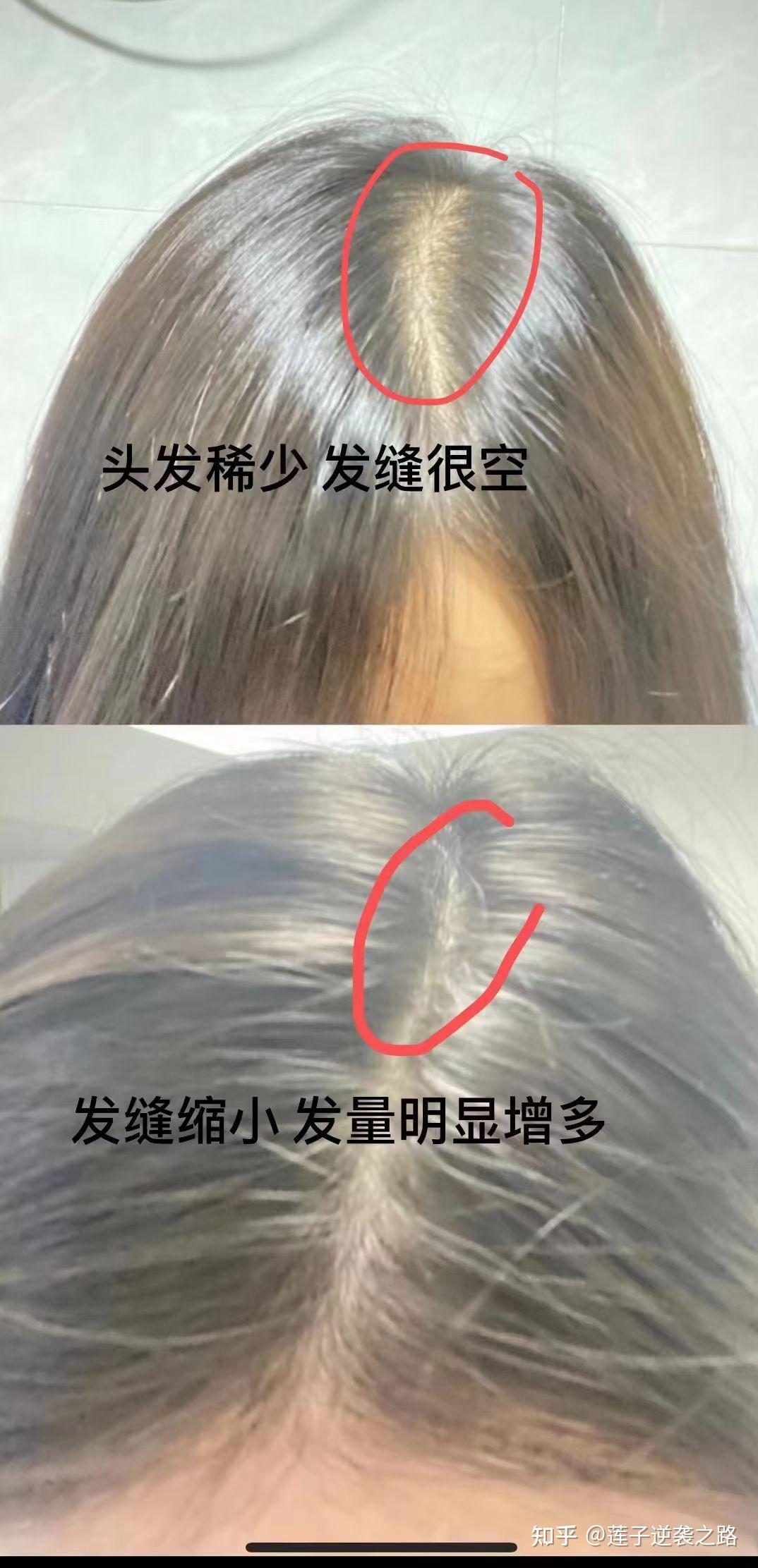 我感觉我发缝太宽了 都要秃顶了 我是高三才开始疯狂掉头发的 我该怎么拯救我的头发? - 知乎