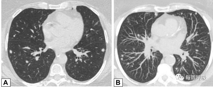 图片[9]-CHEST综述：机化性肺炎的诊断流程（临床-影像-病理特征相关性） | 每周呼吸-每周呼吸