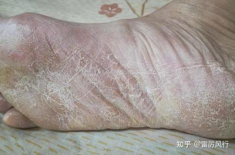 脚干裂首先要分清楚是真菌感染引起还是皮肤干燥缺水引起.