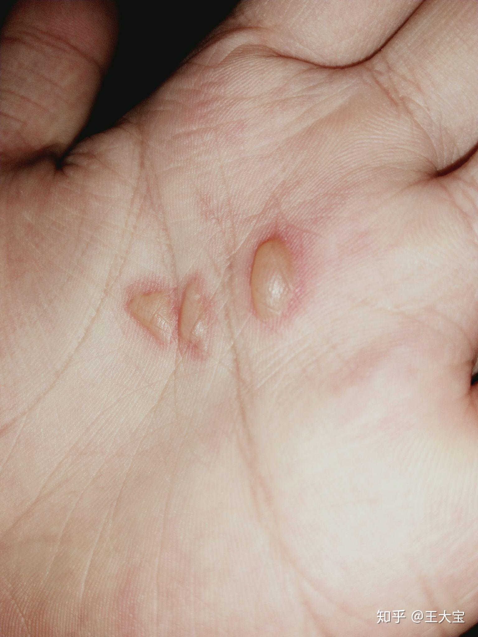 烫伤起的水泡可以戳破吗