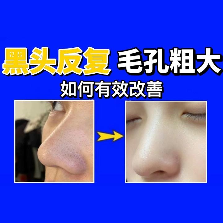 如何28天让黑头连根拔起？去黑头收缩毛孔的最好方法是什么？【皮肤科主任】手把手教你正确去黑头、收毛孔！ - 知乎