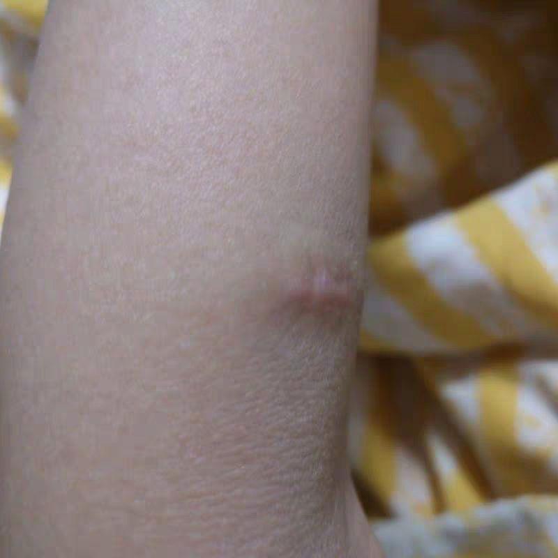 全切双眼皮加开眼角两个月了眼角白色疤痕明显请问各位这个情况需要