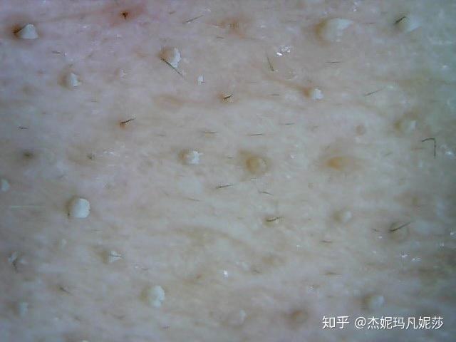 脸上几乎每个毛孔里都能挤出白色的东西是什么要怎么才能清除干净