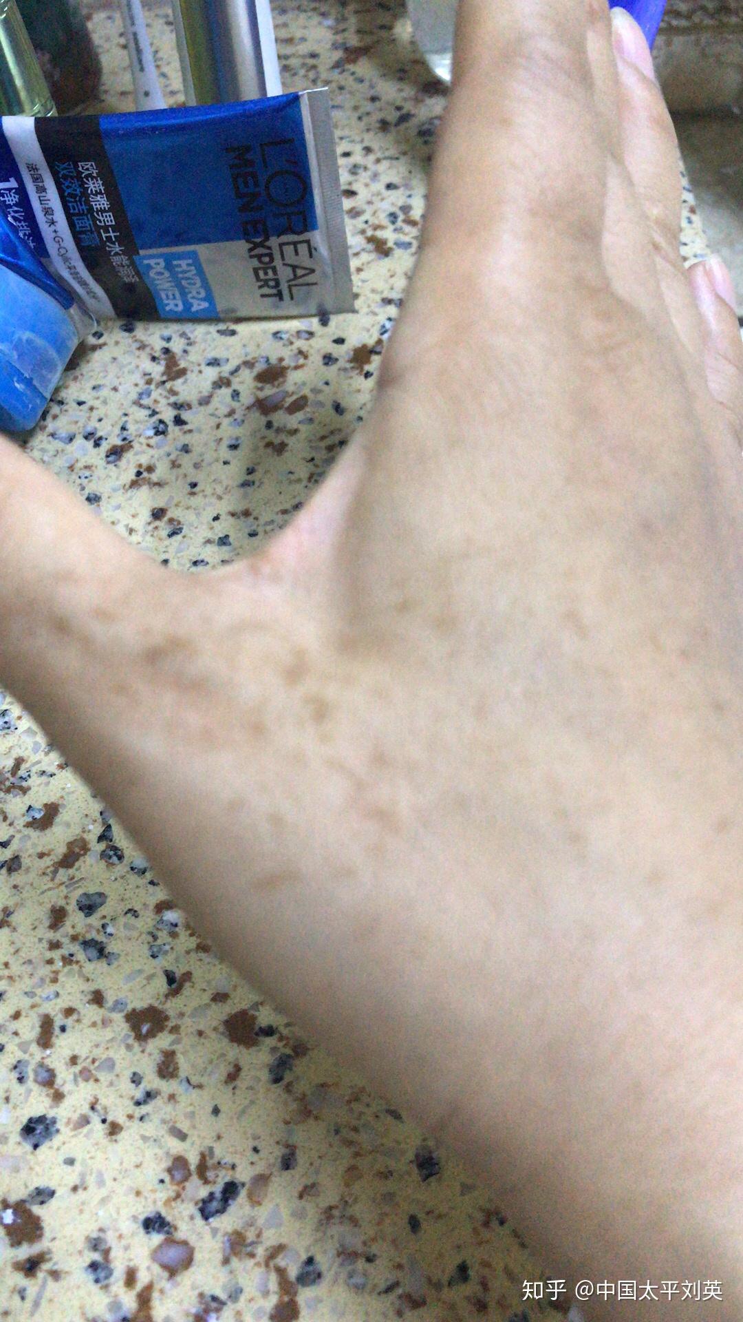 手上长了一些像斑一样的东西到底是什么呢