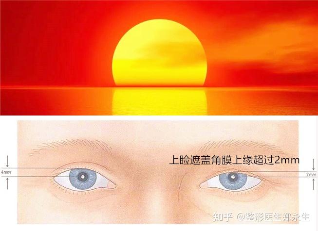 三个月宝宝落日眼图片图片