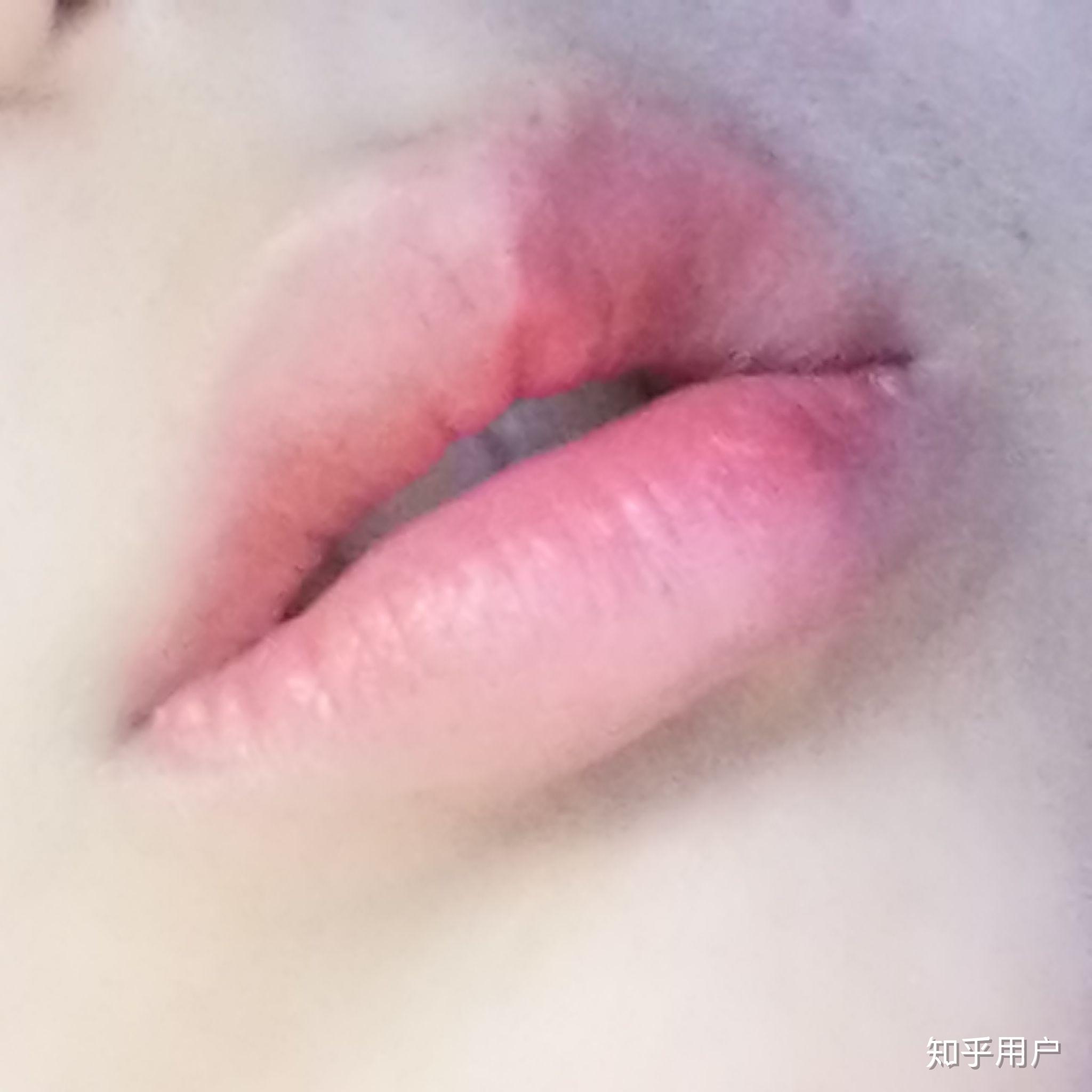 嘴唇很容易起皮经常咬结果本来长唇珠的位置凹进去一块 怎么办?