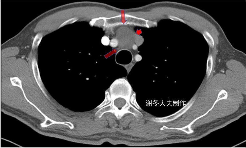 胸腺ct图片位置图解图片