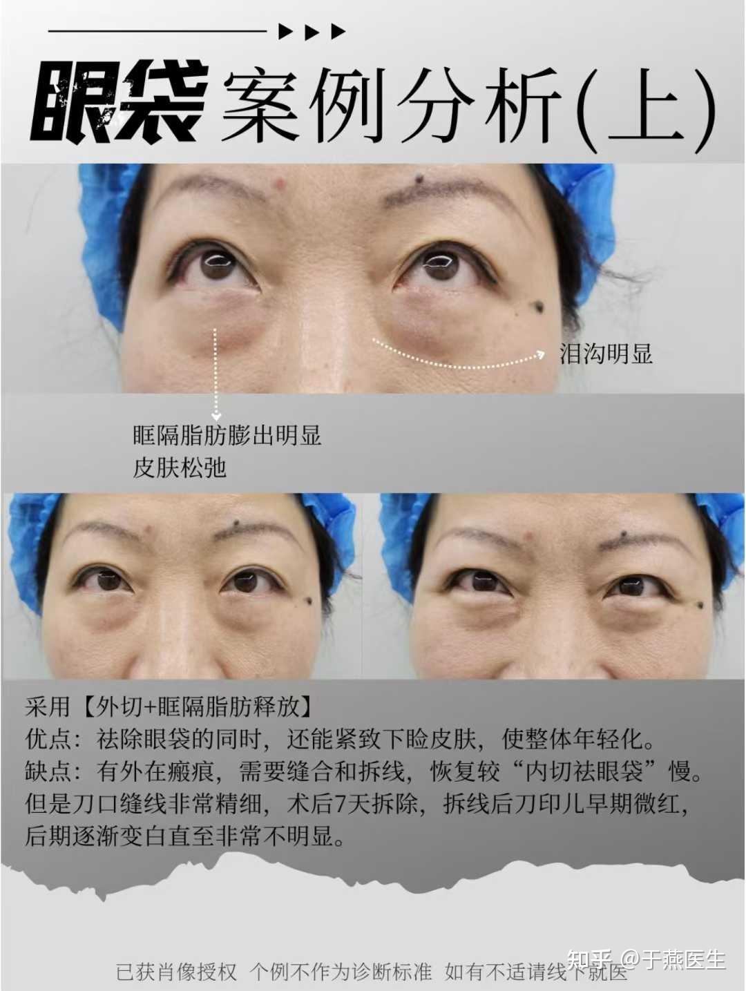 外切眶隔案例解析:什么人更适合外切+眶隔？ - 知乎