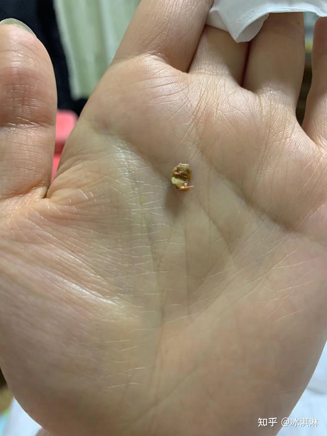 耳朵里长硬耳屎(耵聍)是什么感受? - 知乎