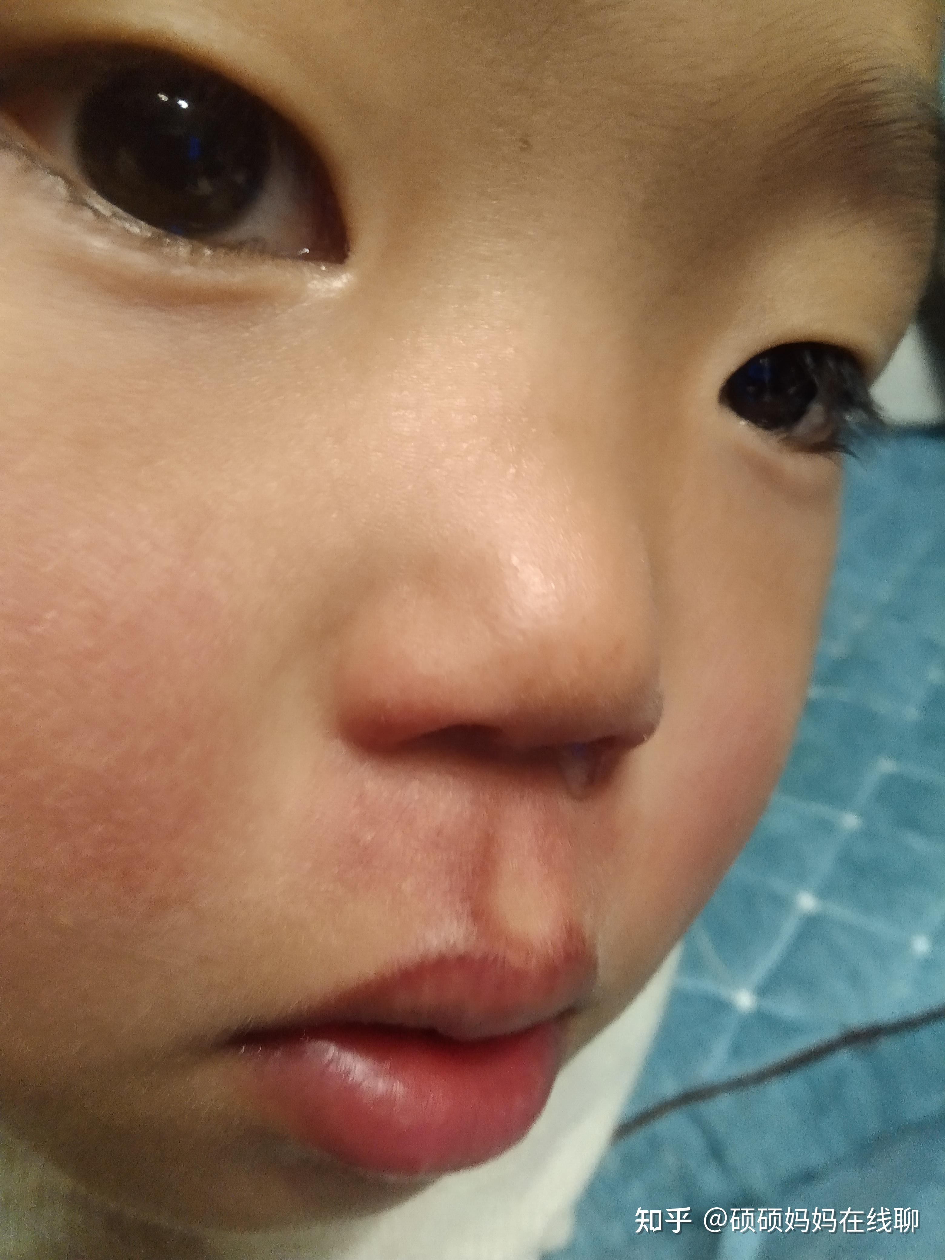 宝宝一到冬天鼻子就被擦破,有什么适合宝宝使用的纸巾吗? - 知乎