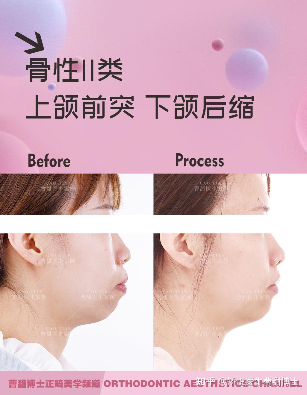 带牙套会改变脸型吗? - 知乎