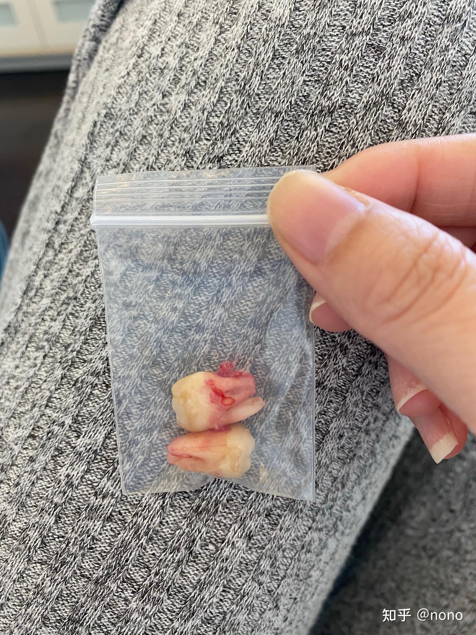 你们的智齿在什么情况下才拔掉的