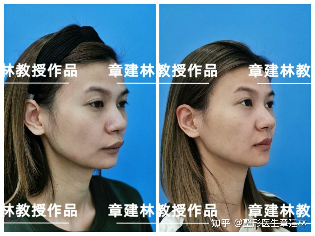 如图我这个下巴和嘴唇为啥有一个凹陷的地方这个应该是做牙齿正畸还是