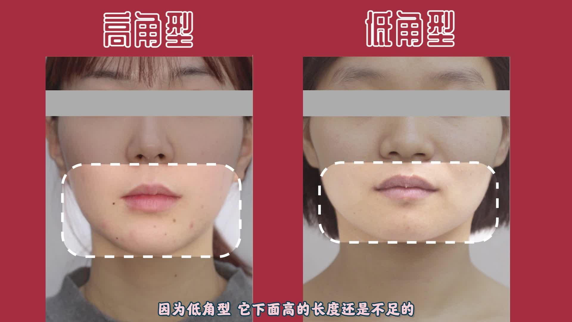 正畸医生为什么不肯给低角面型拔牙高角低角面型到底怎么看