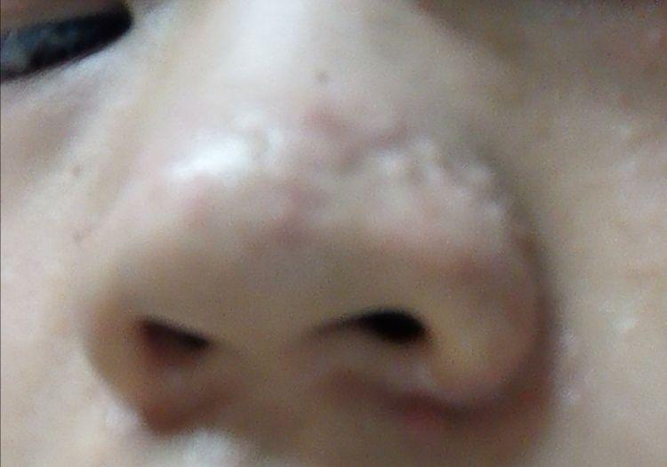 鼻子上增生和凹凸不平能用点阵激光治疗吗