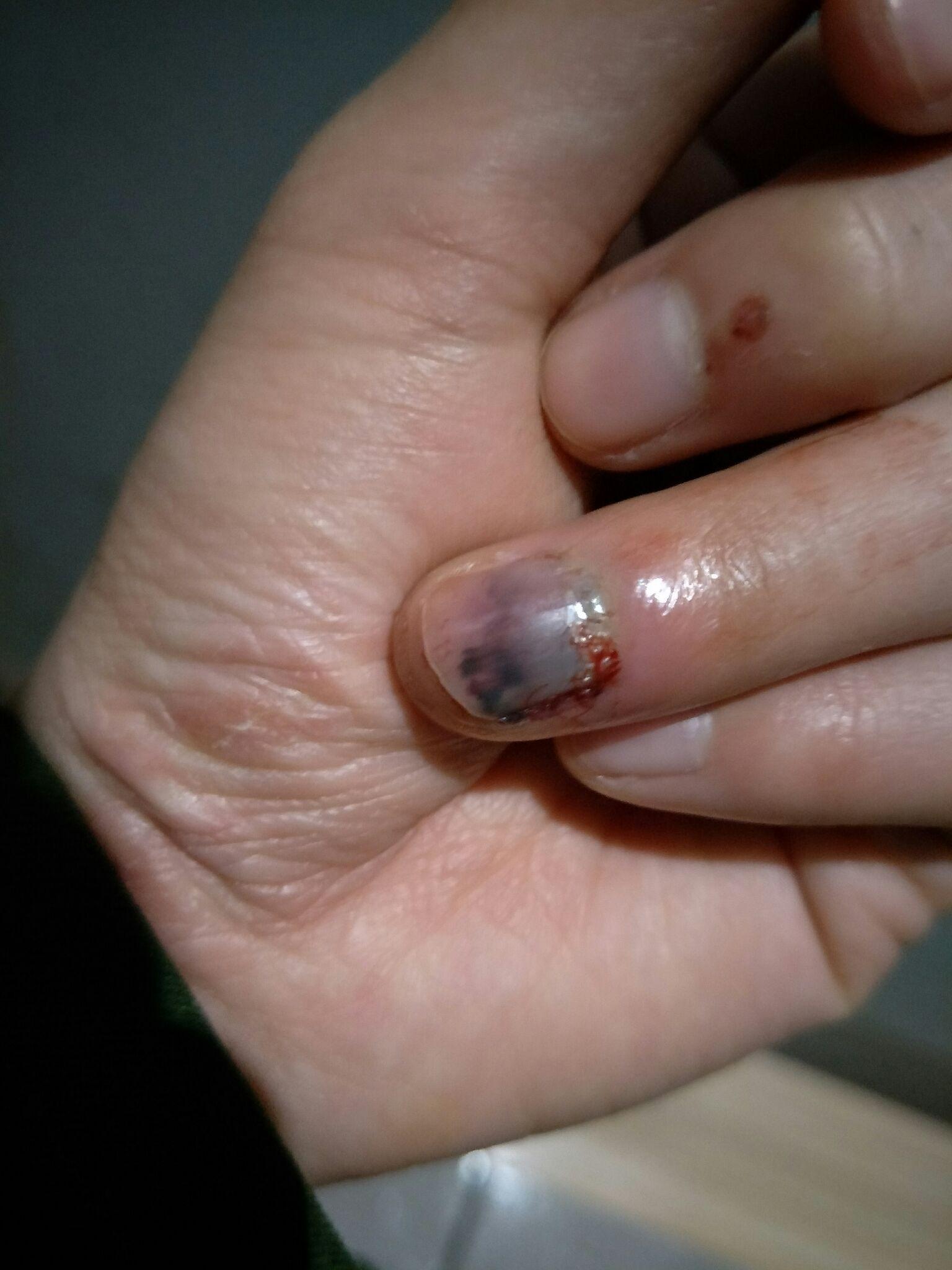 手指被门夹到飙泪是种怎样的体验