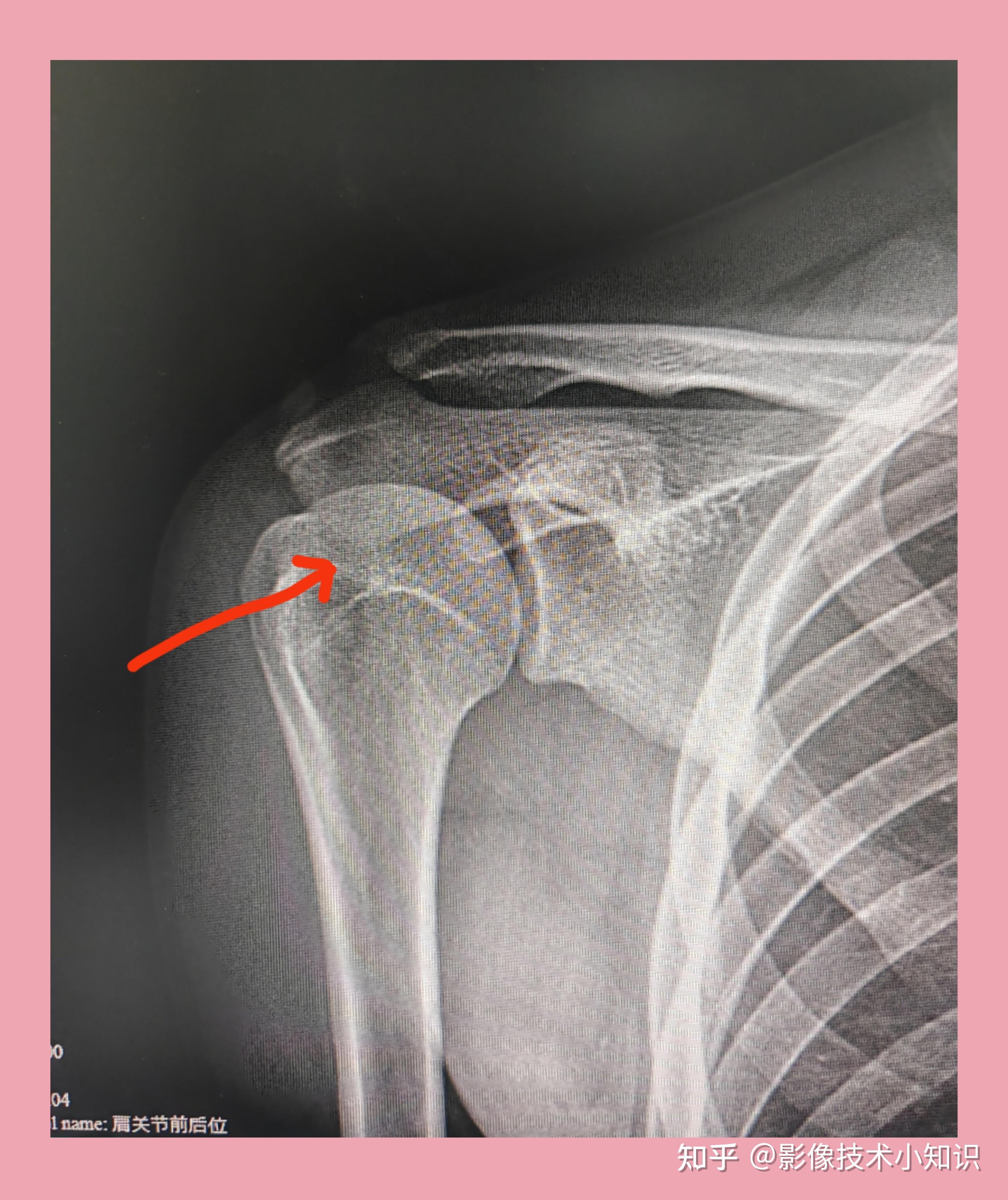 为什么为什么两个肩膀肩峰处一个高一个平缓,为什么啊?