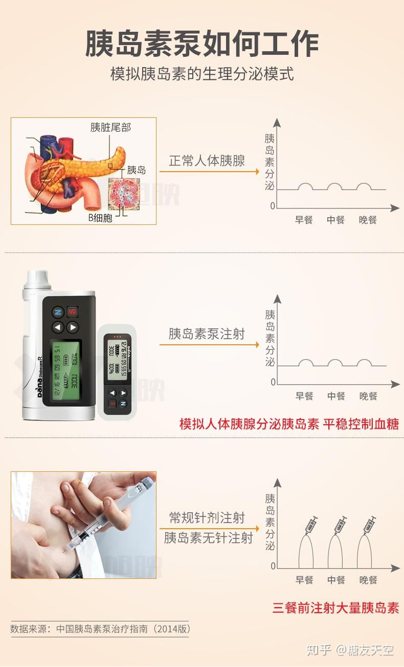 使用胰島素泵有什麼好處