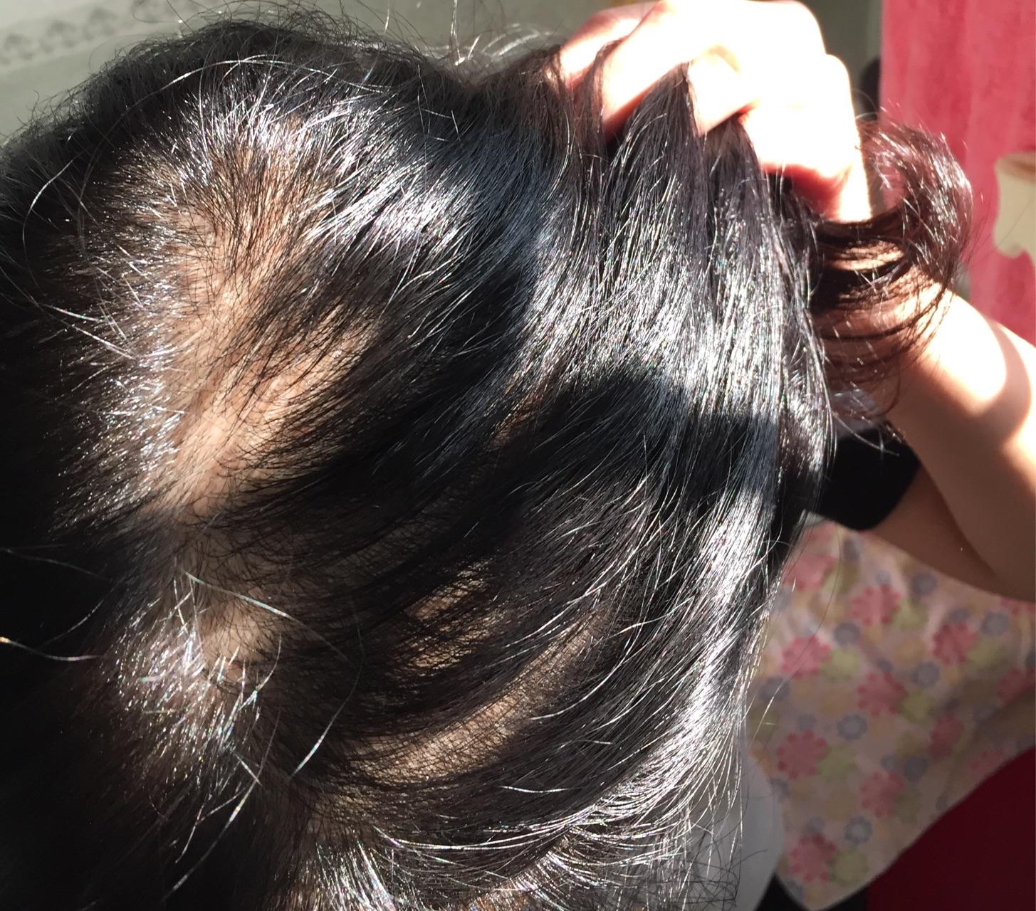 24岁女生,头顶非常稀疏,细软少?