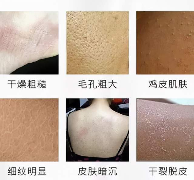 全身干痒、紧绷、腿上都是“蛇皮”!秋季肌肤怎么拯救! - 知乎