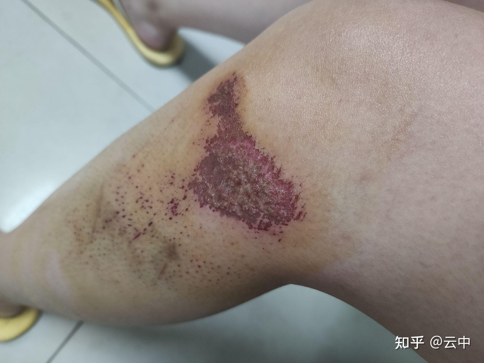 电动车撞人了,造成对方皮外伤.现在找我要2000元. - 知乎