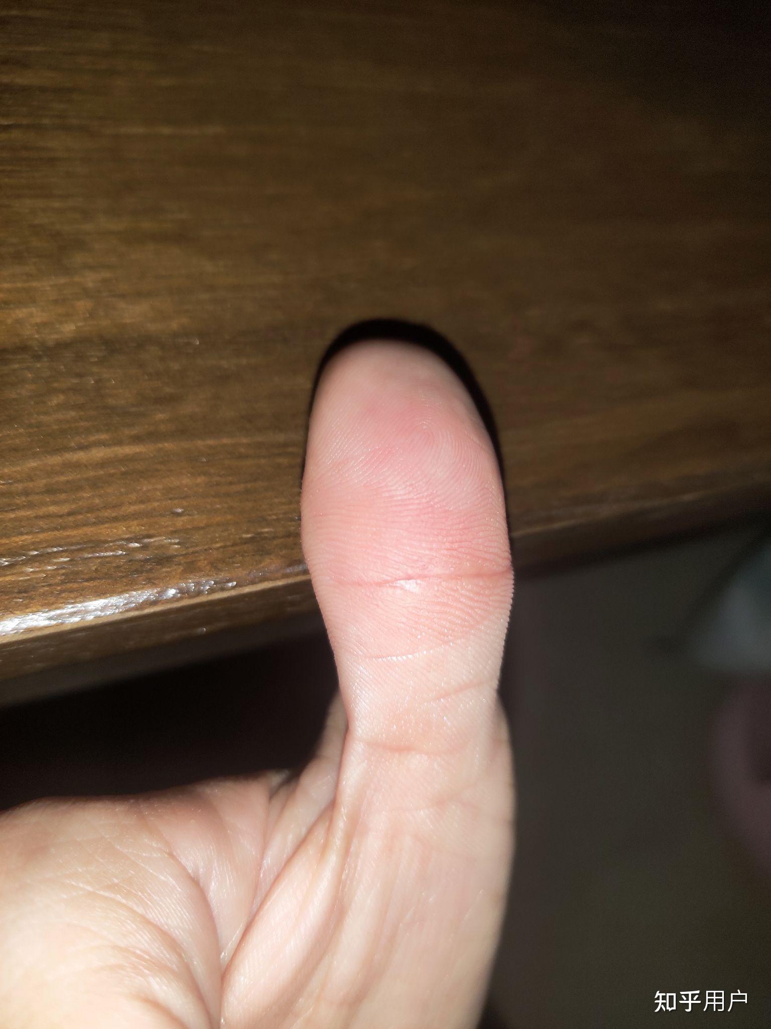 大拇指内侧皮肤发硬喜欢撕下角质层十年了怎么能恢复正常皮肤哦