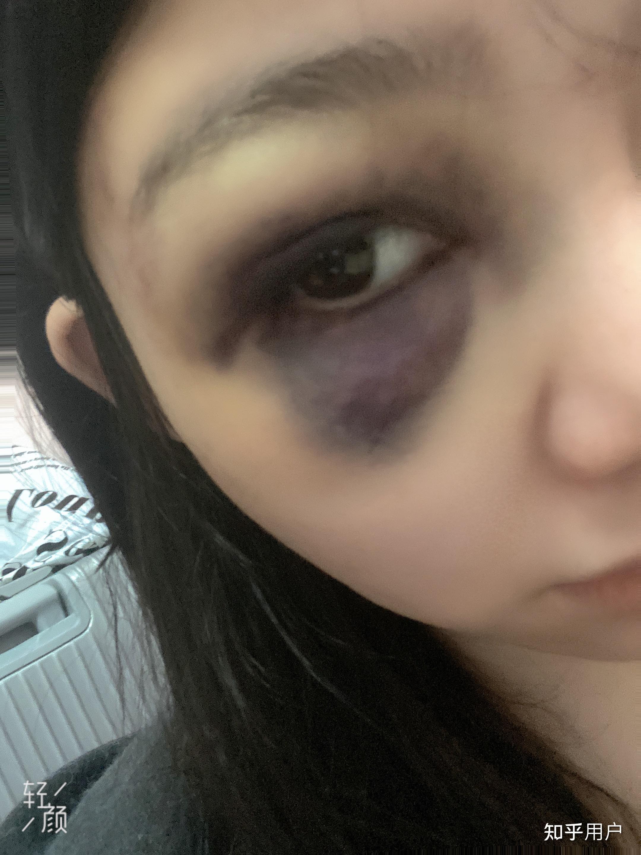 想知道眼部淤青怎么可以快速消除? - 知乎