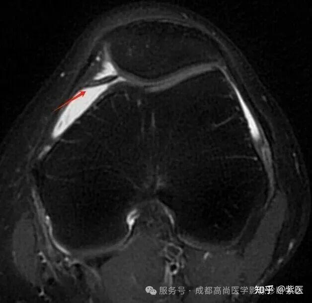 膝关节滑膜皱襞综合征(MPS)MR诊断 - 知乎