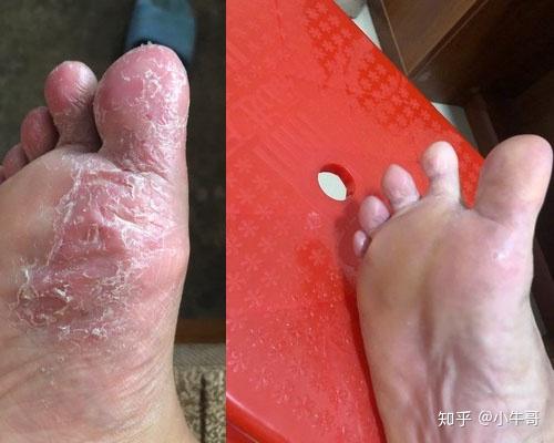 脚缝间脱皮怎么办不痛不痒不臭