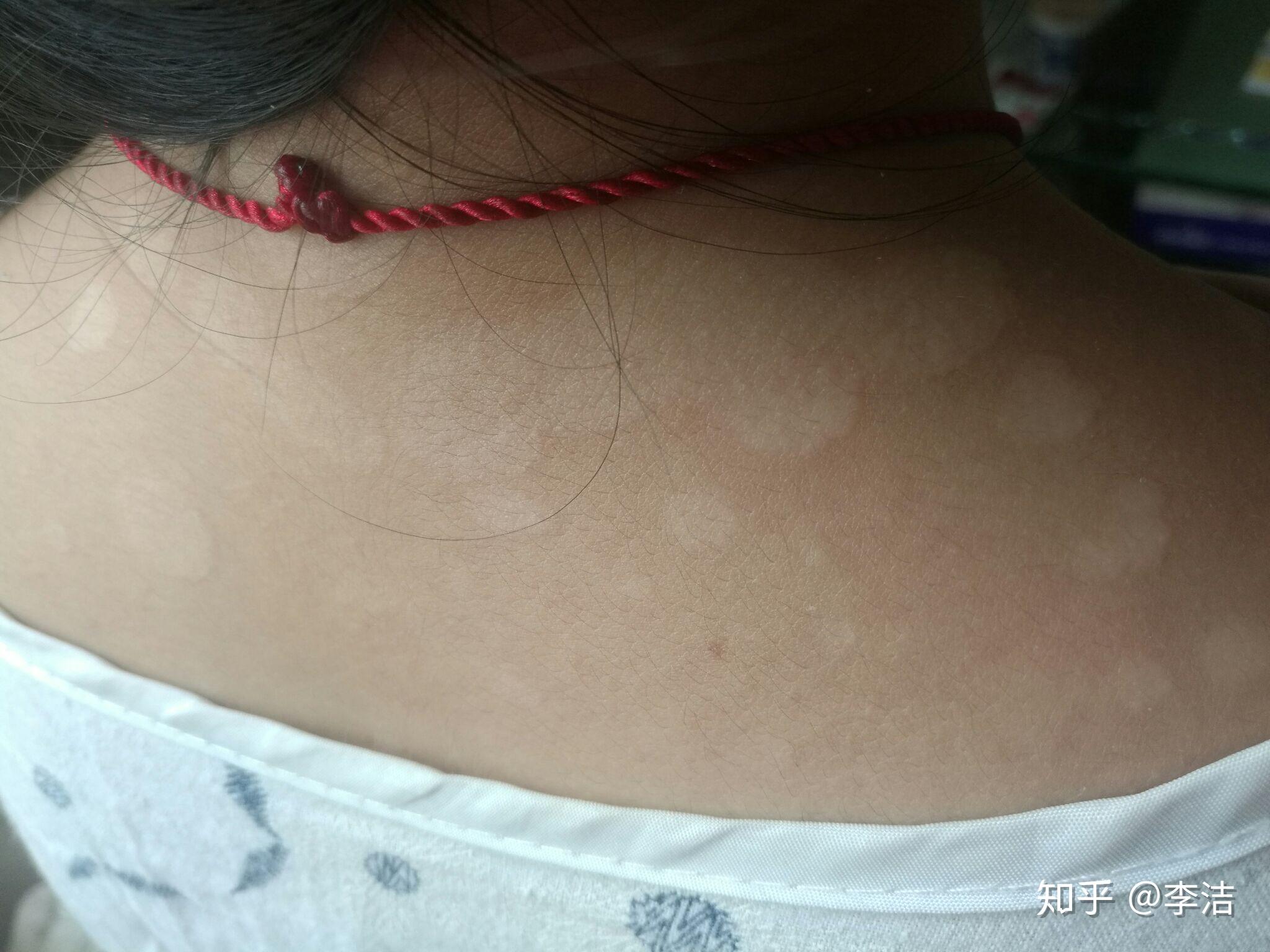 脖子到肩膀长白色斑是什么.