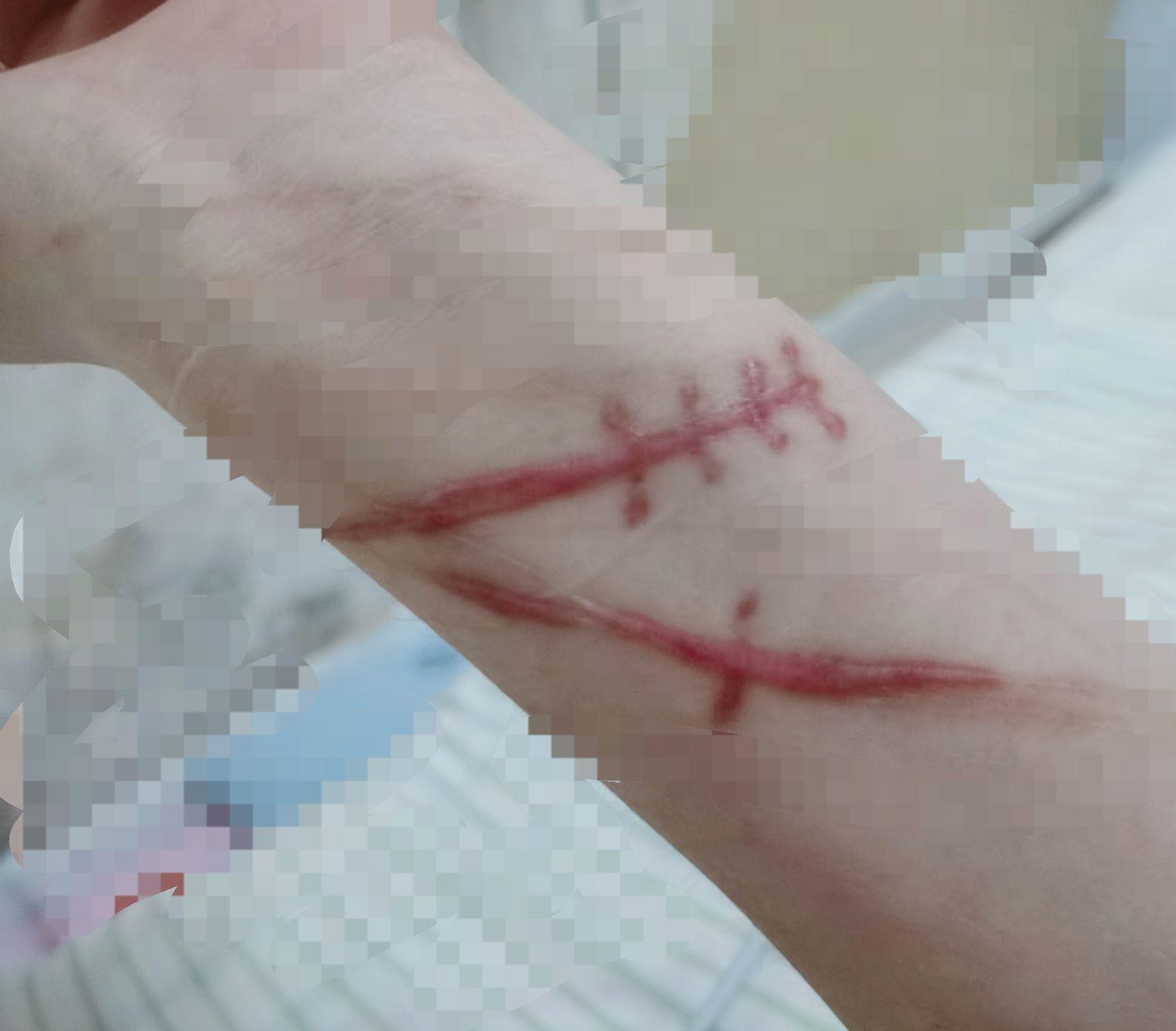手腕割伤疤痕图片