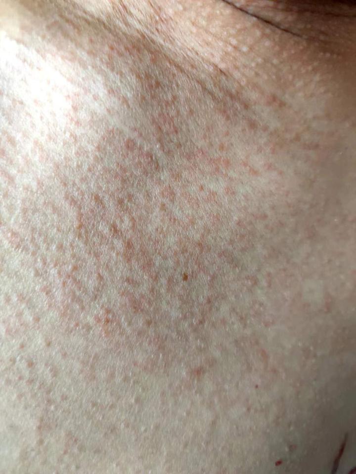 hiv急性期症状【病毒疹】【发热】【淋巴结肿大】【腹泻】等等,我是