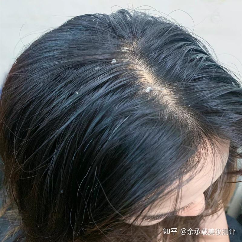 头皮屑又多又痒用什么洗发水?洗头膏去屑止痒控油推荐 - 知乎